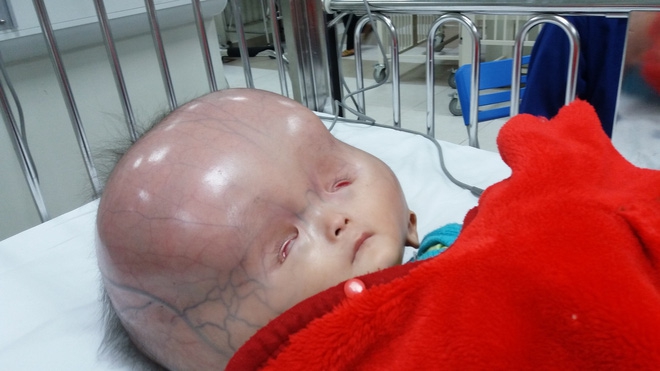 Vụ bé trai có cái đầu to khác lạ bị bố bỏ mẹ con đi lấy vợ khác: Tiên lượng xấu, gia đình xin về