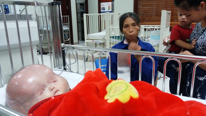 Vụ bé trai có cái đầu to khác lạ bị bố bỏ mẹ con đi lấy vợ khác: Tiên lượng xấu, gia đình xin về