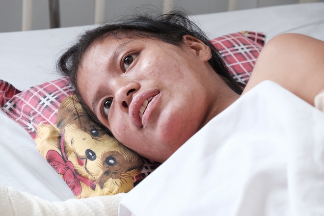 Nến rớt xuống bình xăng dưới giường, hai mẹ con thai phụ bỏng nặng, chồng chưa cưới ôm tiền ủng hộ bỏ trốn