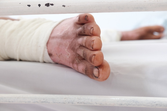 Nến rớt xuống bình xăng dưới giường, hai mẹ con thai phụ bỏng nặng, chồng chưa cưới ôm tiền ủng hộ bỏ trốn