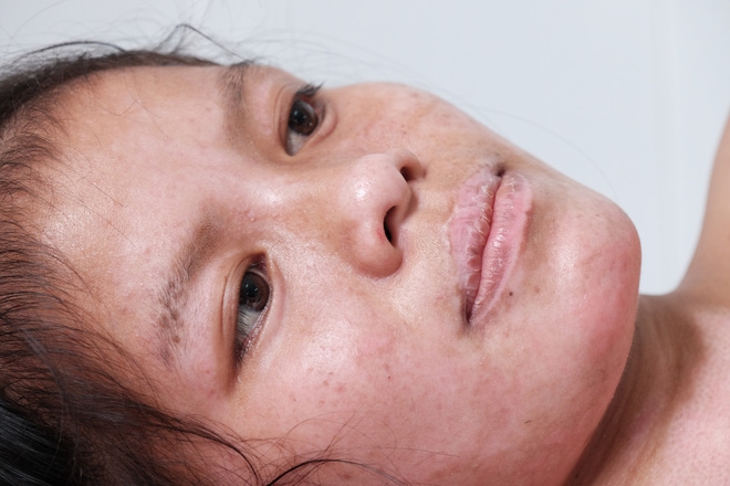 Nến rớt xuống bình xăng dưới giường, hai mẹ con thai phụ bỏng nặng, chồng chưa cưới ôm tiền ủng hộ bỏ trốn