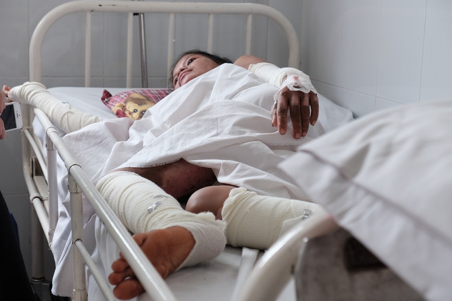 Nến rớt xuống bình xăng dưới giường, hai mẹ con thai phụ bỏng nặng, chồng chưa cưới ôm tiền ủng hộ bỏ trốn