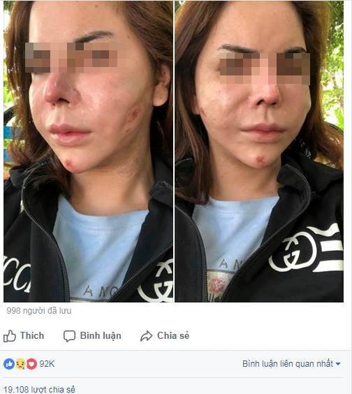 Cô gái chuyển giới mặt biến dạng sau khi nạo silicone