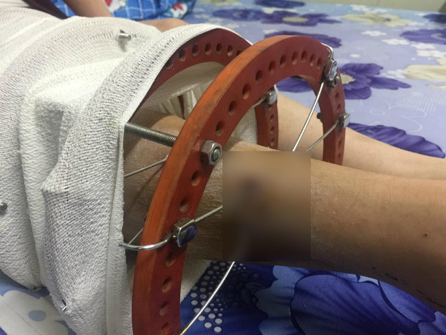 Hoàn cảnh nghiệt ngã của người đàn ông có con gái mắc ung thư xương, vợ mất vì u hạch