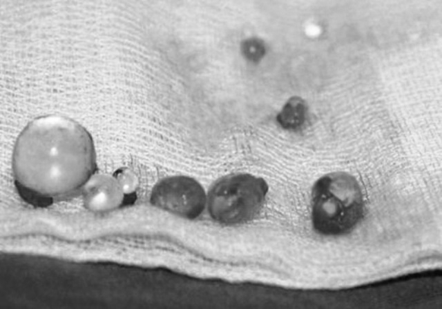 TP.HCM: Nam bệnh nhân chỉ bị tiểu buốt nhưng phòng khám cắt luôn gốc dương vật còn bắt trả 23 triệu đồng