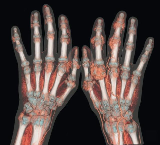 Căn bệnh nhà giàu gây đau đớn khủng khiếp: Đừng quên 10 nguyên tắc để phòng tránh