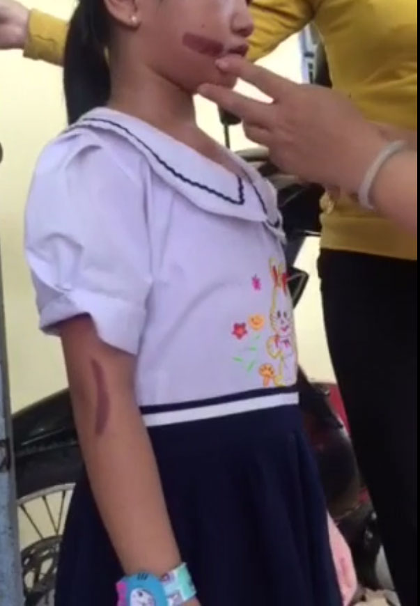 Cháu bé 7 tuổi nghi bị dí sắt đỏ vào người về sống cùng bà nội