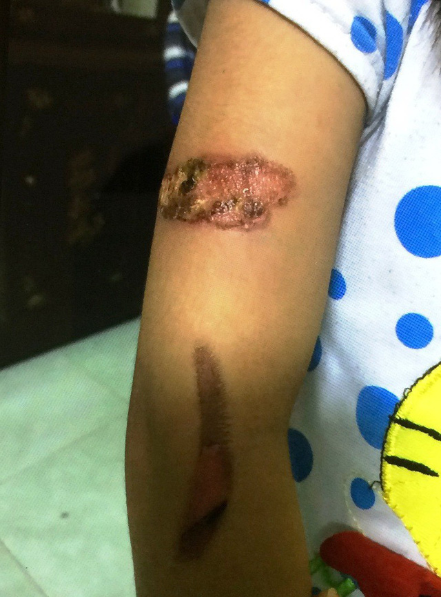 Cháu bé 7 tuổi nghi bị dí sắt đỏ vào người về sống cùng bà nội