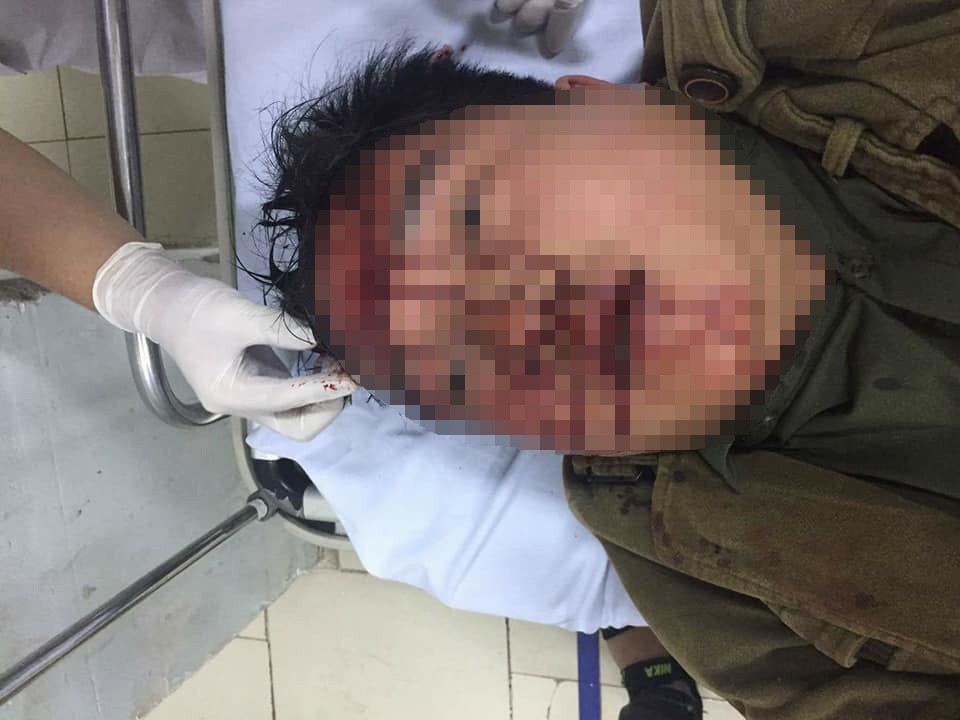 Một cán bộ đoàn xã bị đánh liên tiếp vào đầu phải khâu nhiều mũi