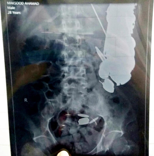 Người đàn ông có 263 đồng xu và 100 móng tay trong bụng