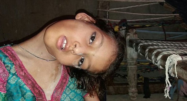 Cô bé chỉ nhìn thôi đã mỏi: Đầu cổ luôn cong vẹo 90 độ đến mức không đi được