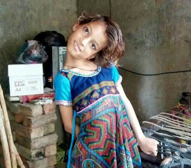 Cô bé chỉ nhìn thôi đã mỏi: Đầu cổ luôn cong vẹo 90 độ đến mức không đi được