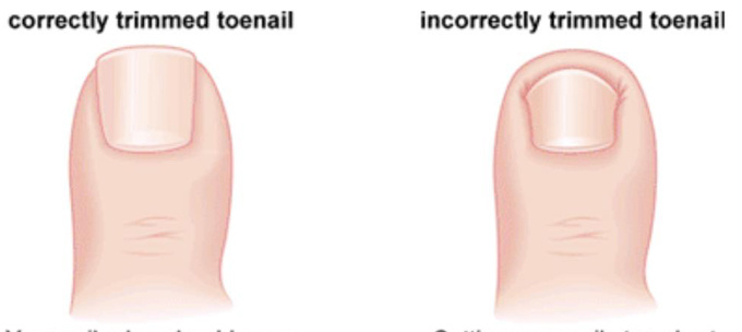 Xử trí khi móng chân mọc đâm chọc vào da