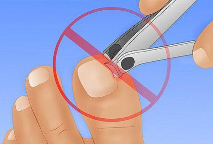 Xử trí khi móng chân mọc đâm chọc vào da