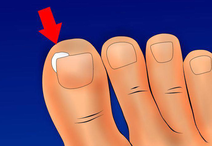 Xử trí khi móng chân mọc đâm chọc vào da