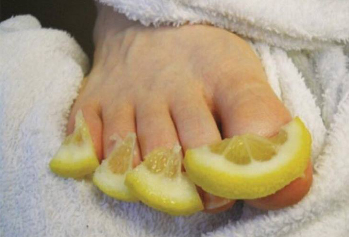 Xử trí khi móng chân mọc đâm chọc vào da