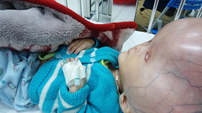 Người mẹ bị tố không đồng ý đưa con bị não úng thủy sang Singapore chữa trị lên tiếng