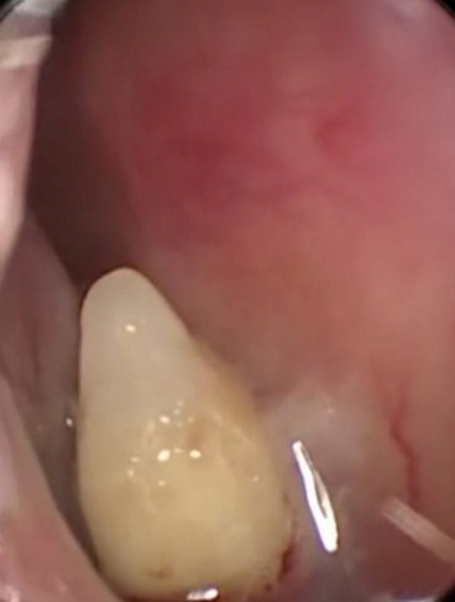 Lạ đời mũi biết... mọc răng