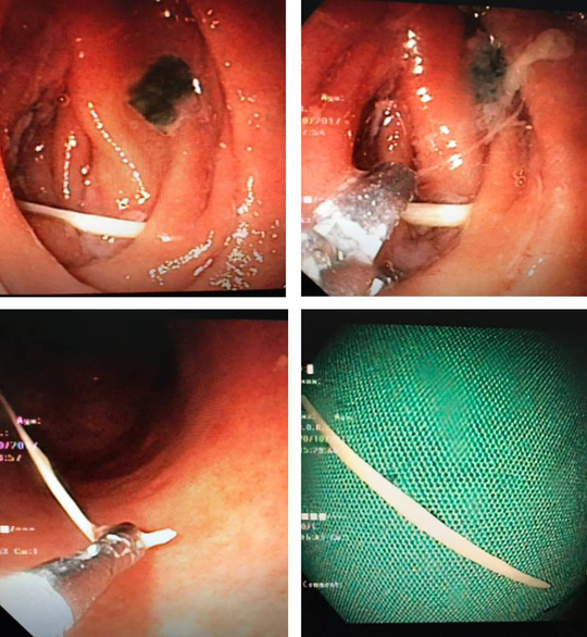 Tăm tre đâm thủng ruột cụ bà