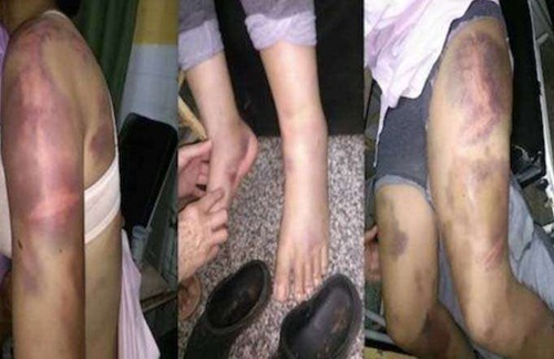 Bị bạn trai đánh đến biến dạng vì ảnh được nhiều Like trên Facebook