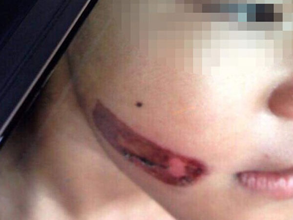 Công an thực nghiệm hiện trường vụ bé gái nghi bị gí sắt nóng vào người