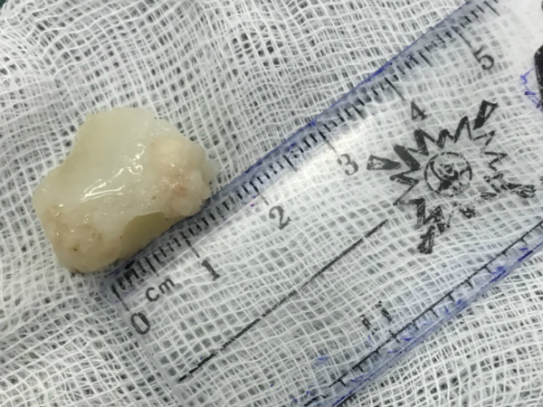 Miếng sườn lợn kẹt ở thực quản làm cụ ông tưởng nhầm ung thư