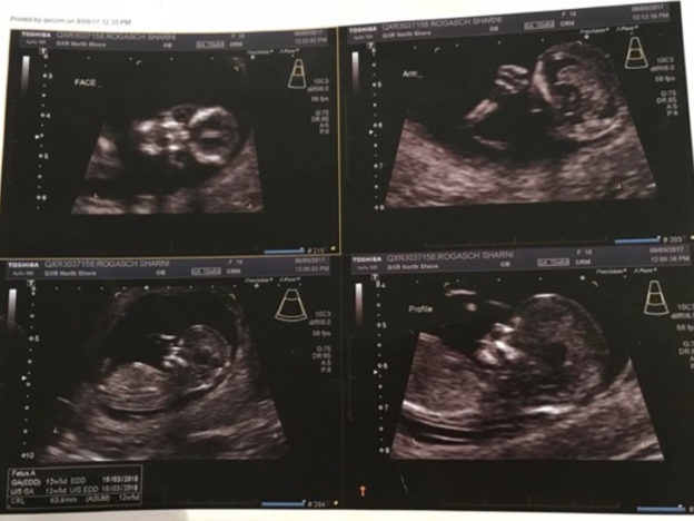 Mẹ trẻ Úc vừa chia sẻ ảnh siêu âm, cư dân mạng liền hốt hoảng gọi đứa trẻ trong bụng cô là “ác quỷ”