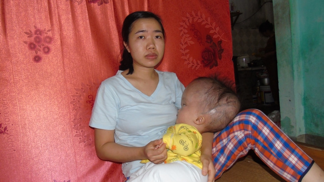 Cuộc sống đau đớn của bé gái 8 tháng tuổi mồ côi cha, cái đầu như muốn nổ tung vì căn bệnh não úng thủy