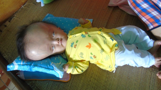 Cuộc sống đau đớn của bé gái 8 tháng tuổi mồ côi cha, cái đầu như muốn nổ tung vì căn bệnh não úng thủy