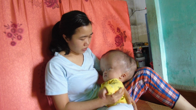 Cuộc sống đau đớn của bé gái 8 tháng tuổi mồ côi cha, cái đầu như muốn nổ tung vì căn bệnh não úng thủy