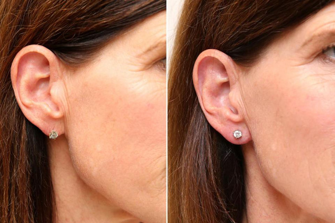 Hết tiêm căng da mặt, chị em còn tiêm filler vào thùy tai để loại bỏ tình trạng chảy xệ của lỗ bấm khuyên Hết tiêm căng da mặt, chị em còn tiêm filler vào thùy tai để loại bỏ tình trạng chảy xệ của lỗ bấm khuyên
