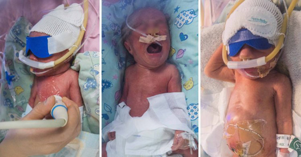 Chị em sinh ba chào đời cách nhau hai ngày