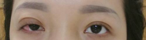 Cô gái vĩnh viễn không thể nhắm mắt sau khi cắt mí làm đẹp