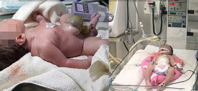 Bé sơ sinh lộ hết ruột gan ra ngoài được phục hồi thành bụng thành công