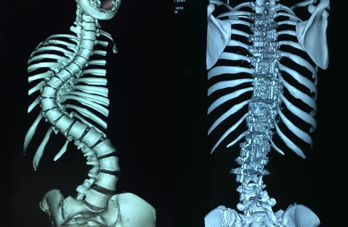 Thiếu nữ có cột sống uốn lượn như xương rắn