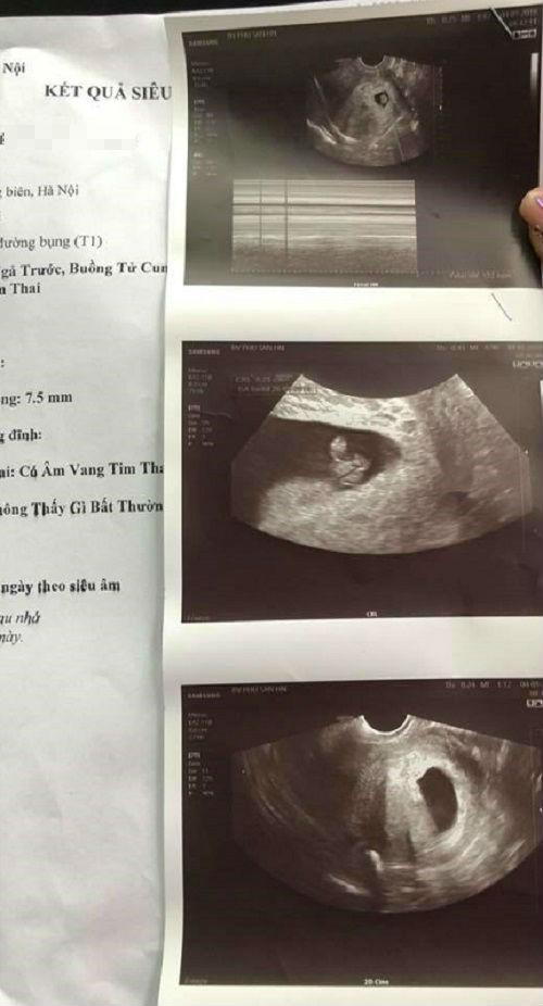 Hà Nội: Bác sĩ khẳng định thai chết lưu cho đi hút, sang viện khác khám thai vẫn bình thường Hà Nội: Bác sĩ khẳng định thai chết lưu cho đi hút, sang viện khác khám thai vẫn bình thường