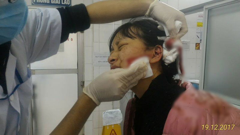 Thanh Hóa: Nữ sinh lớp 11 bị đánh, rạch mặt 14cm phải nhập viện cấp cứu, anh trai cầu cứu cộng đồng mạng