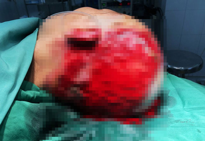 Một phụ nữ Gia Lai hoại tử da đầu nặng, vĩnh viễn không thể mọc tóc sau sự cố làm đẹp kinh hoàng