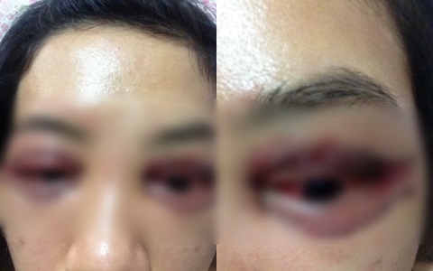 Bọc răng, uốn tóc, cắt mí - Những ca làm đẹp thông thường nhưng đã khiến các nạn nhân tiền mất tật mang