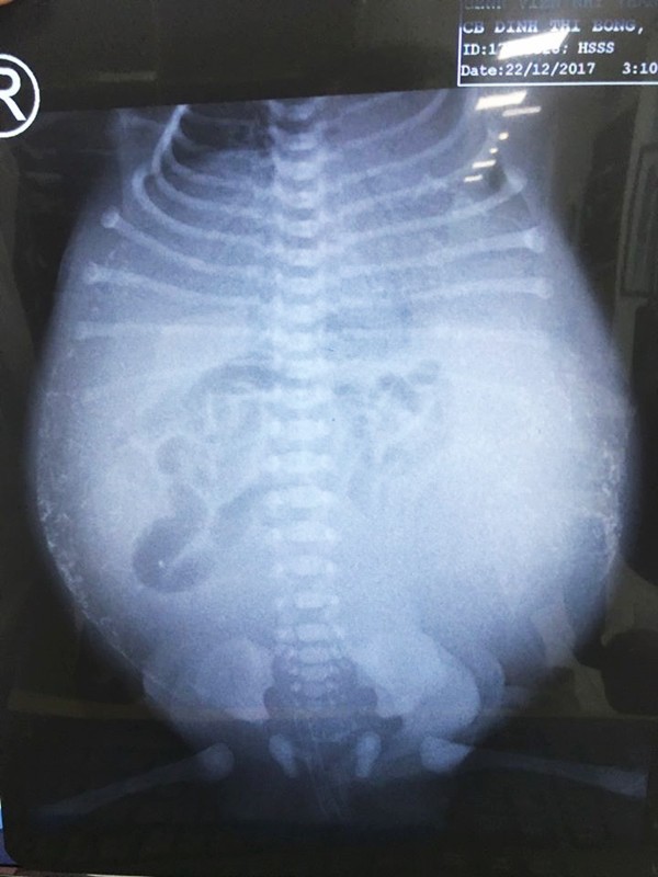 Tưởng không thể qua khỏi, bé trai thủng ruột từ trong bụng mẹ được cứu sống kỳ diệu