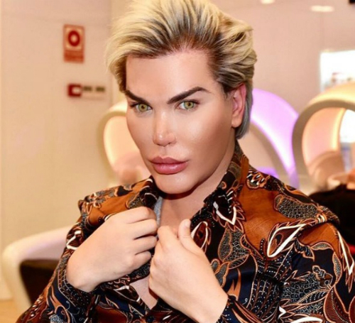 Người đàn ông cắt 4 xương sườn để thu gọn vòng eo