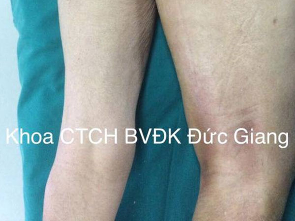 Hãi hùng bệnh nhân tự tiêm thuốc điều trị gout, hút ra 10 lít mủ