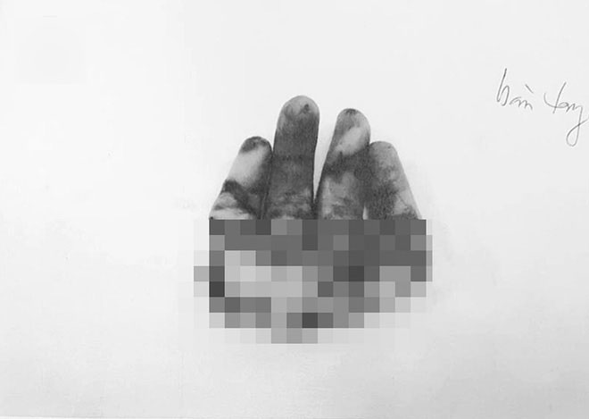 Bình Dương: Bé trai 2 tuổi bị sên xe máy quấn đứt lìa bàn tay