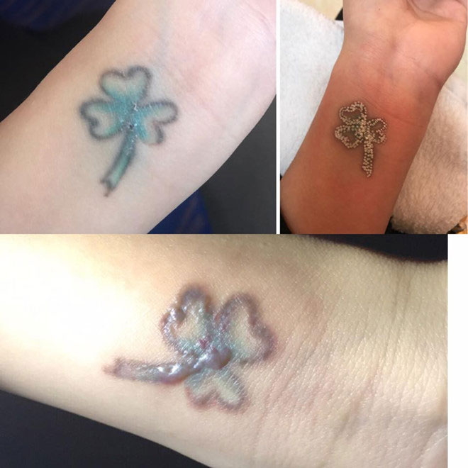 Cô gái xăm hình từ lớp 8 và vết sẹo đi theo cả cuộc đời