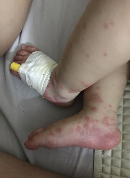 Mẹ tưởng con chỉ bị viêm phổi nhưng cuối cùng lại mắc bệnh lạ nguy hiểm