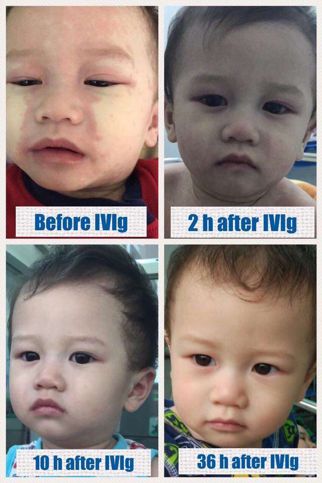 Mẹ tưởng con chỉ bị viêm phổi nhưng cuối cùng lại mắc bệnh lạ nguy hiểm