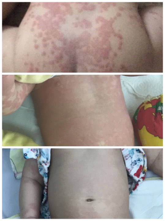 Mẹ tưởng con chỉ bị viêm phổi nhưng cuối cùng lại mắc bệnh lạ nguy hiểm Mẹ tưởng con chỉ bị viêm phổi nhưng cuối cùng lại mắc bệnh lạ nguy hiểm