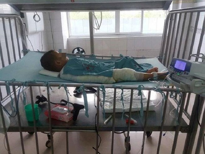 Ngã vào nồi bỗng rượu đang sôi, bé 3 tuổi nguy kịch Ngã vào nồi bỗng rượu đang sôi, bé 3 tuổi nguy kịch