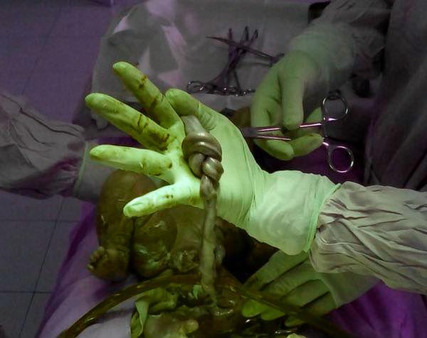 Bà bầu 18 tuổi đi khám thai, bác sĩ yêu cầu mổ cấp cứu, phát hiện điều bất ngờ