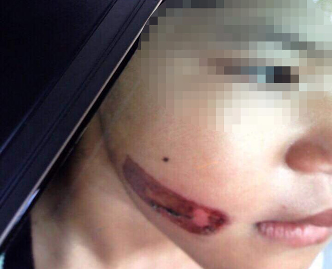 Xin ý kiến Bộ Công an vụ bé gái nghi bị dí sắt nóng vào mặt